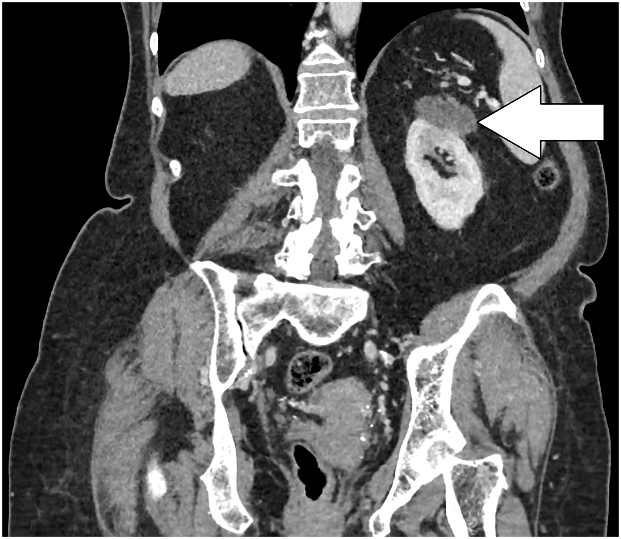 Rare Benign Kidney Tumor Case Highlights Value of Biopsy and Minimally Invasive Treatment